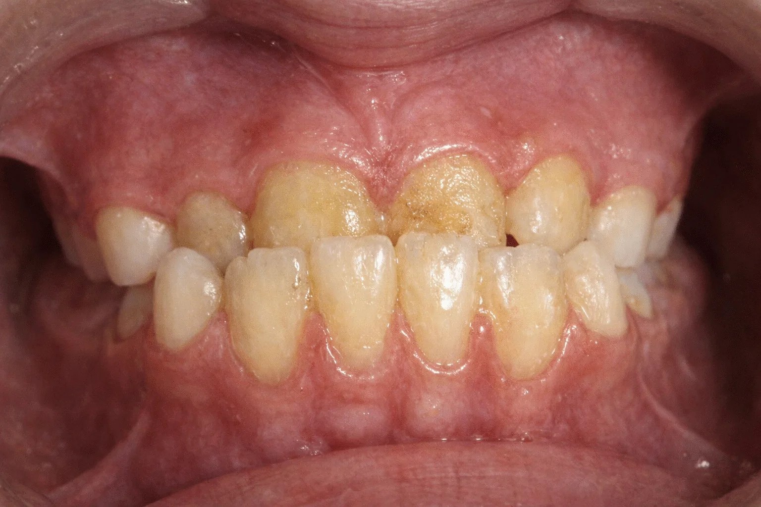 IPR 시술 후 공간이 개선된 모습
